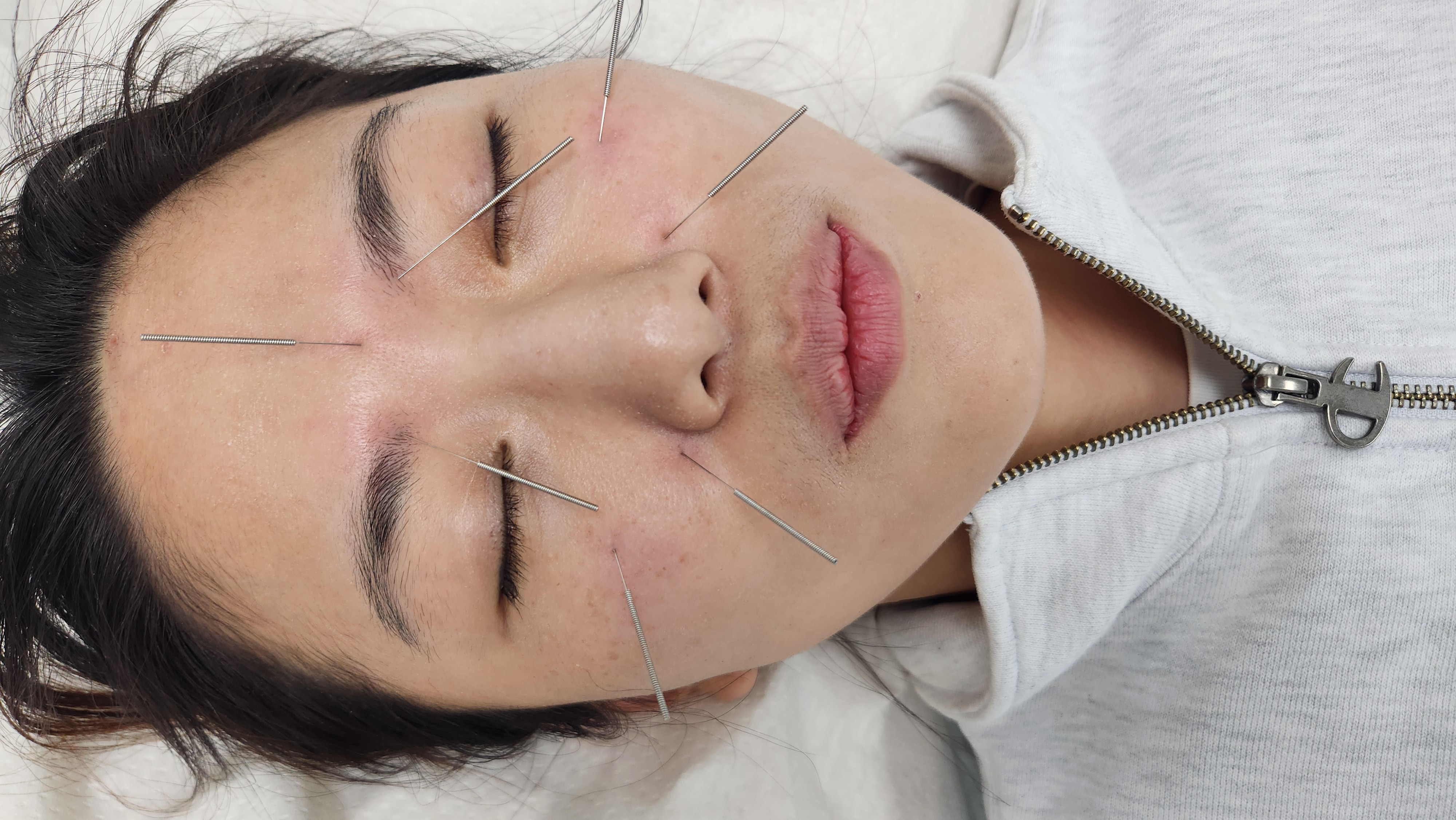 Detail of acupuncture placement around the nose during a RootCare session