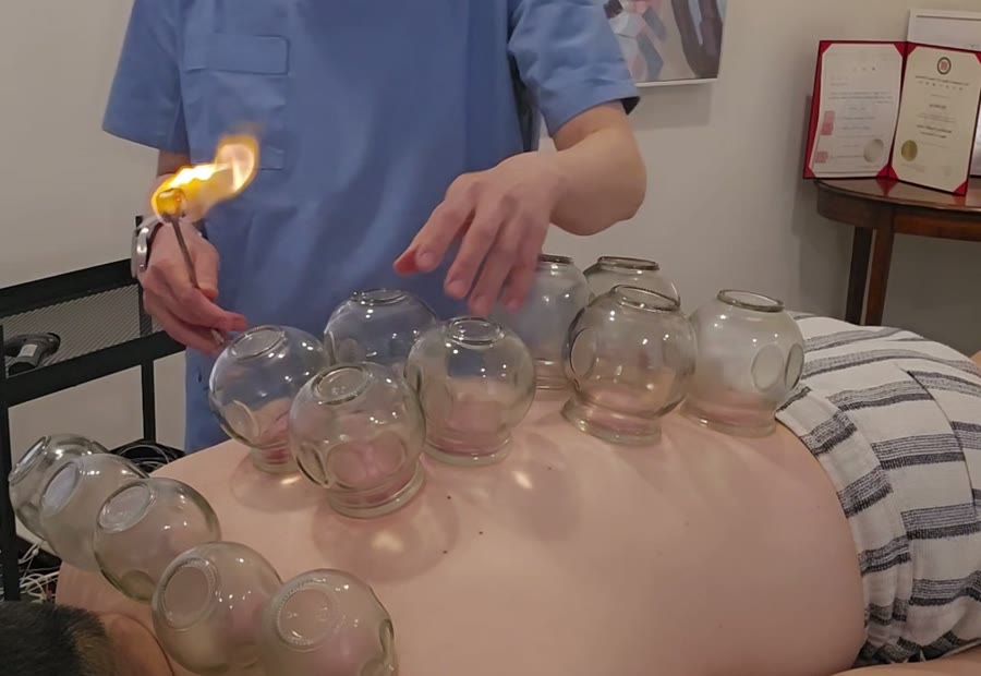 Still frame from a real cupping treatment at RootCare