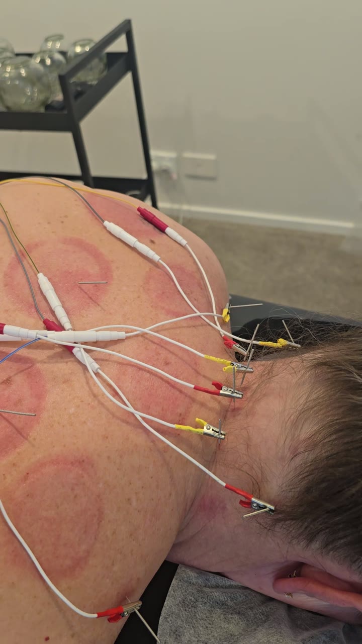 Electro-acupuncture clips used during a real RootCare treatment