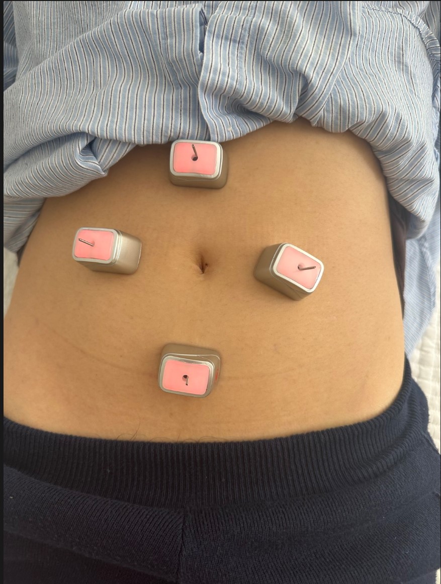 Electro moxa treatment