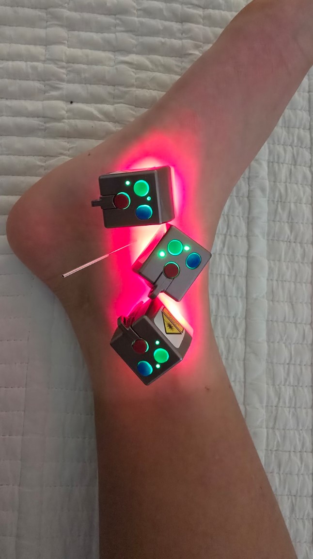 Laser acupuncture treatment